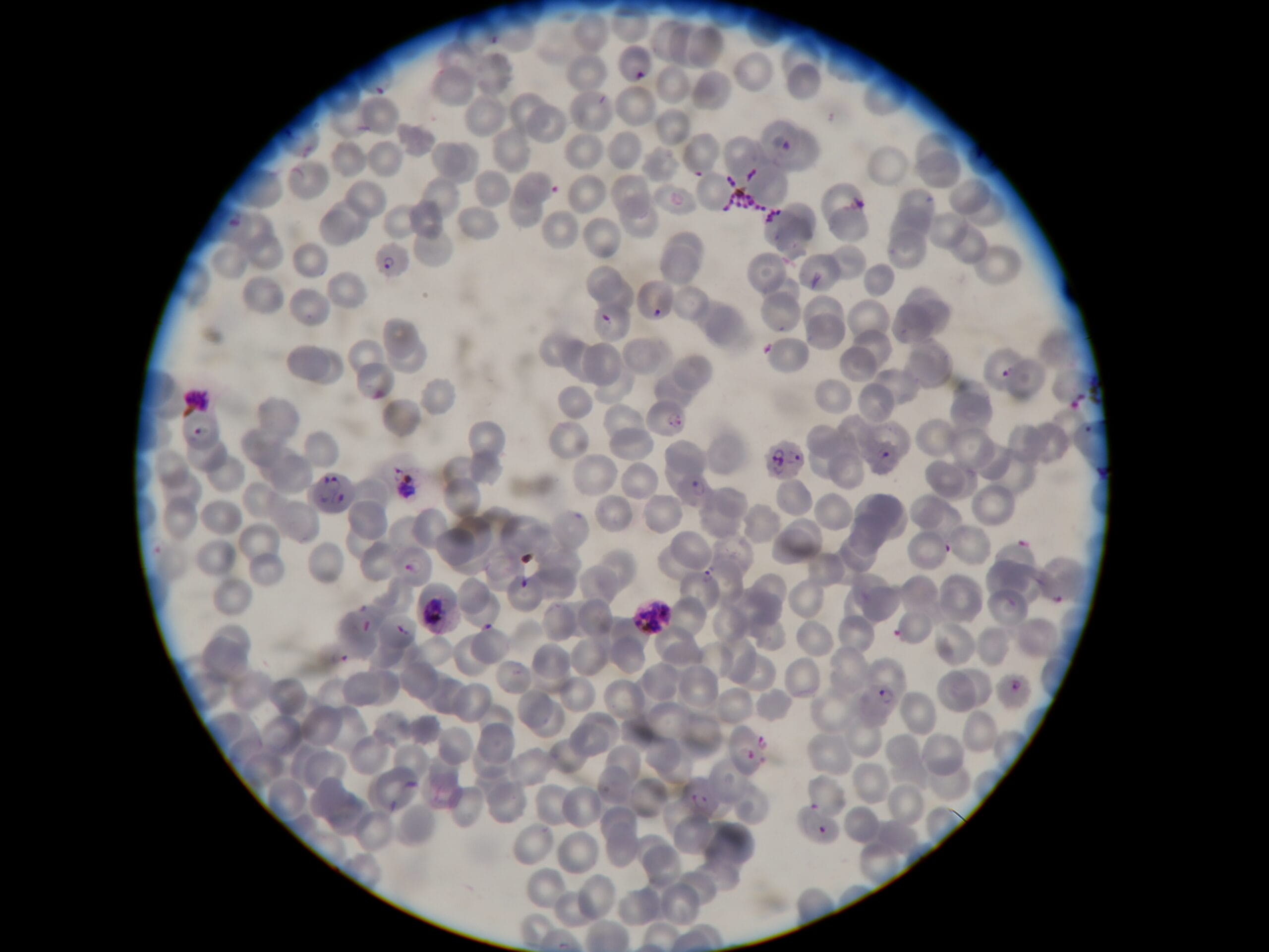 Malaria parasites in blood sample under the microscope